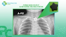 Phòng ngừa và xử lý dị vật đường tiêu hóa ở trẻ em: Câu chuyện từ Bệnh viện Đa khoa Phương Chi