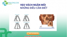 Vẹo Vách Ngăn Mũi Và Những Điều Cần Biết