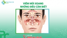 Viêm Mũi Xoang: Những Điều Cần Biết