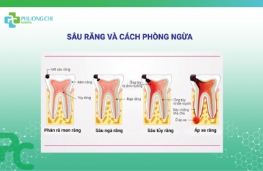 Sâu Răng Và Cách Phòng Ngừa