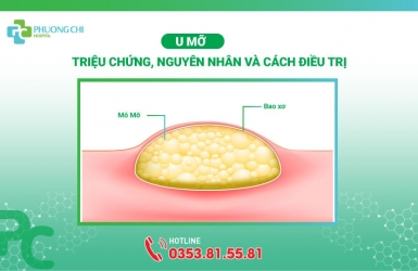 U mỡ: Triệu chứng, nguyên nhân và cách điều trị