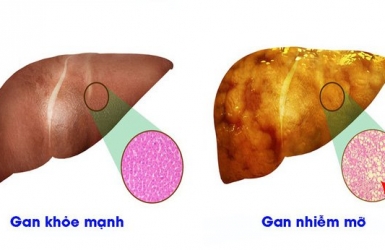 Gan nhiễm mỡ những thông tin cần biết