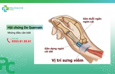 Hội chứng De Quervain và những điều cần biết