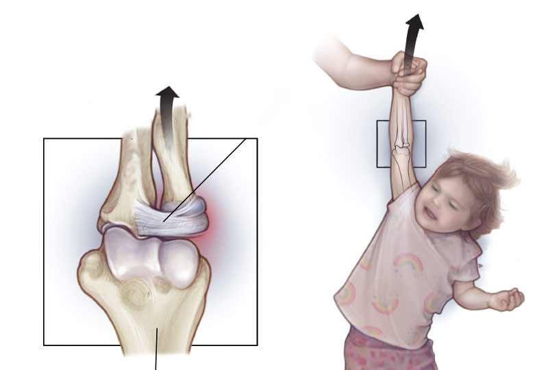 Trật khớp bán phần khớp ở khuỷu tay