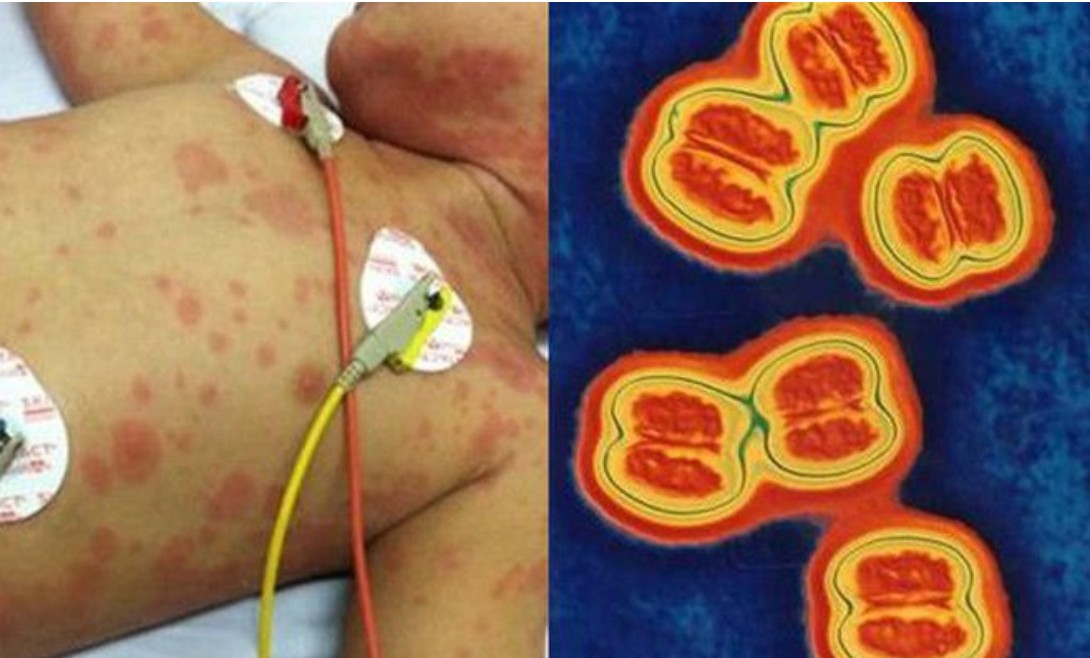 bệnh viêm não mô cầu