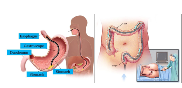 nội soi dạ dày, đại tràng