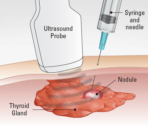sinh thiết bướu giáp nhân