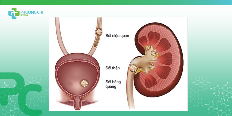 nguyên nhân gây đau quặn thận