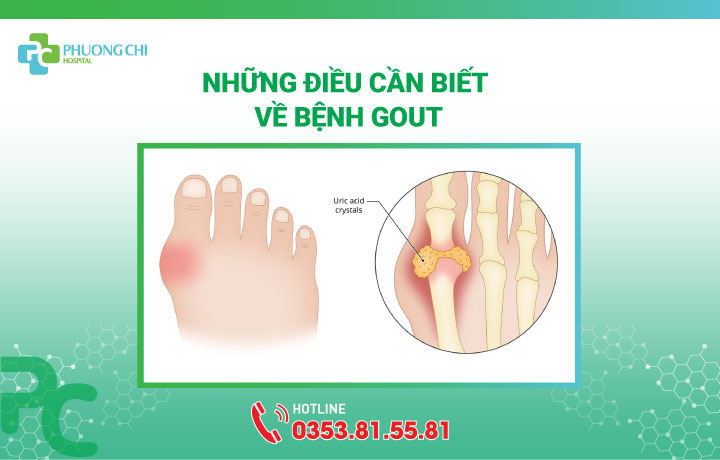 bệnh gout