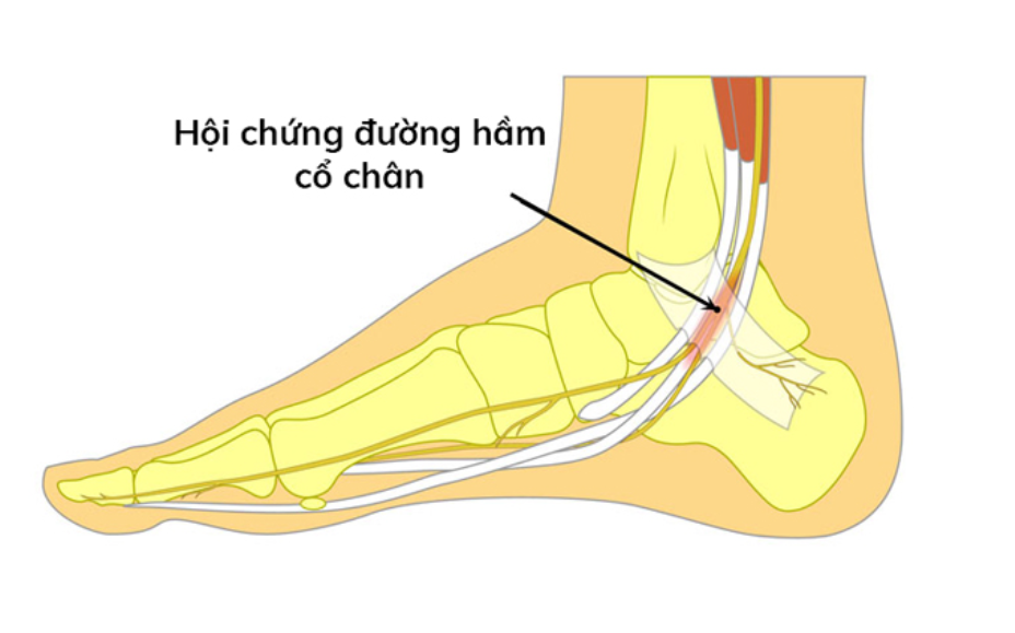 hội chứng đường hầm cổ chân
