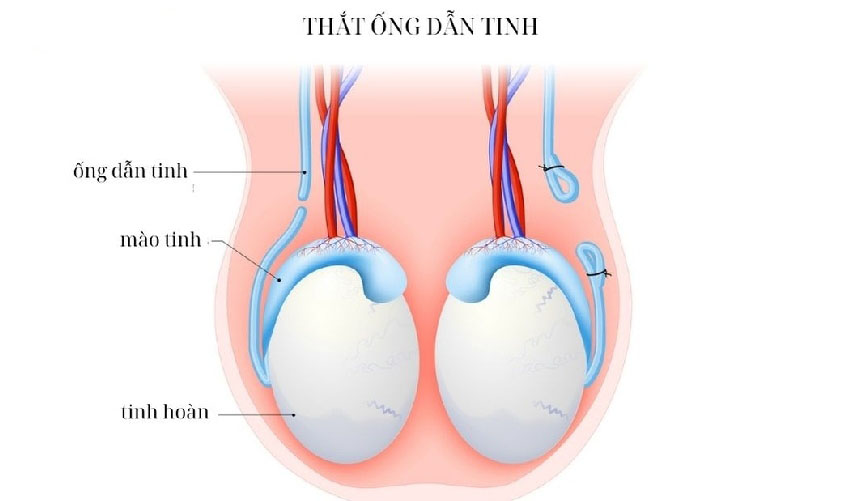 thắt ống dẫn tinh