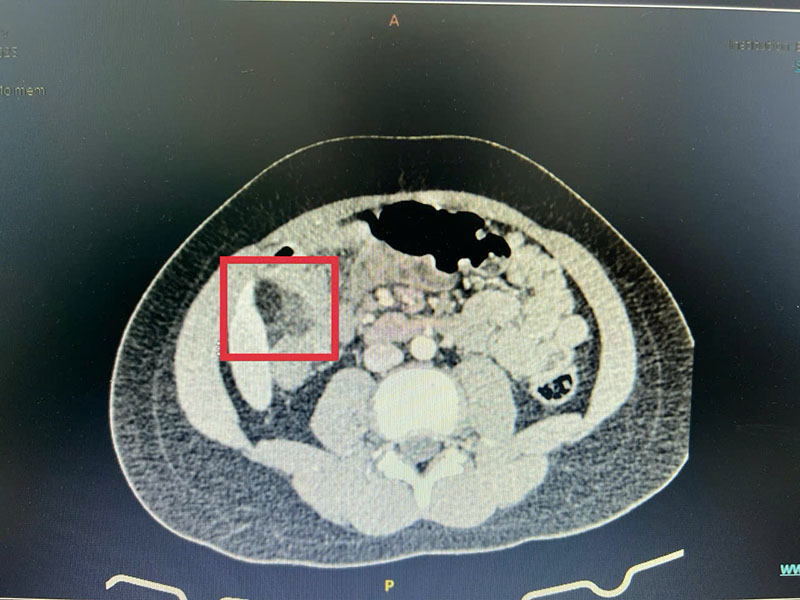 chụp CT scan ổ bụng