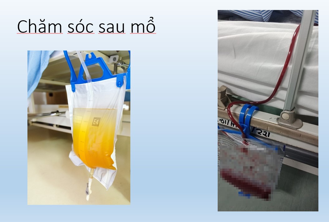 chăm sóc sau mổ