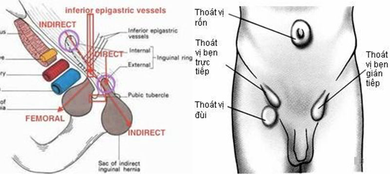 thoát vị bẹn triệu chứng