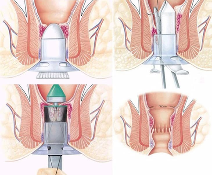 cắt trĩ bằng phương pháp longo