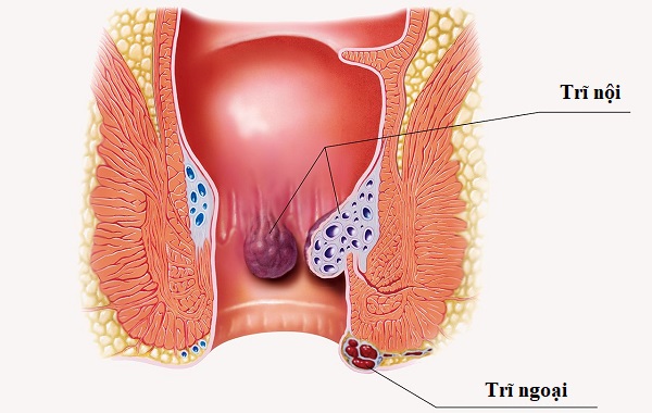 khai niệm về trĩ