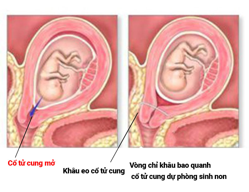 4. Quá Trình Đặt Vòng Nâng và Chăm Sóc Sau Đặt